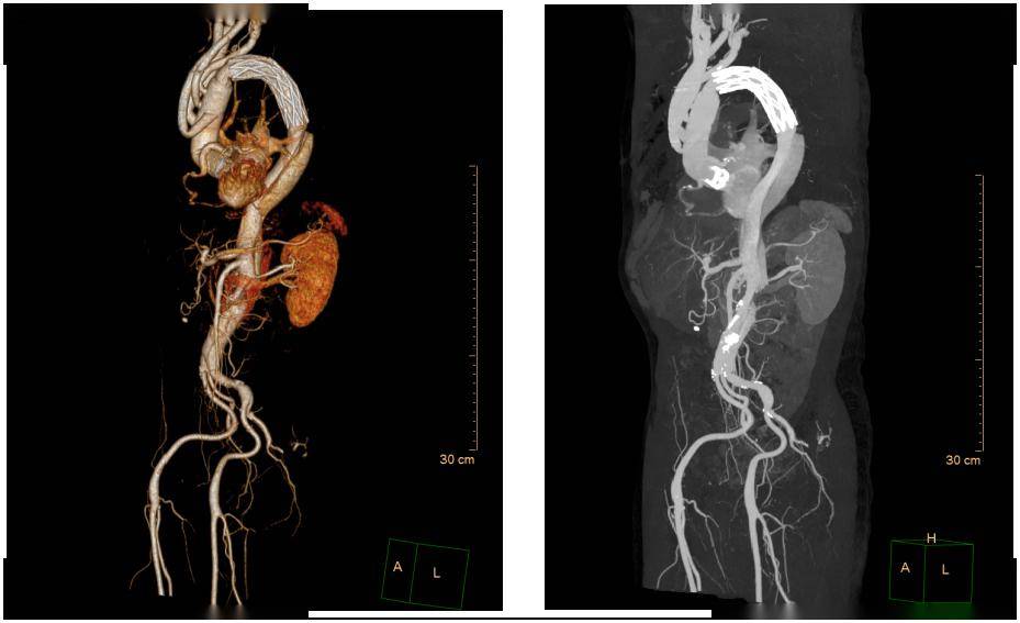 主动脉CTA图片