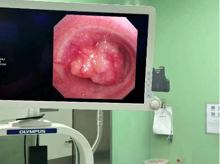 健康中国看山西:山西省汾阳医院心胸外科首例主气管肿