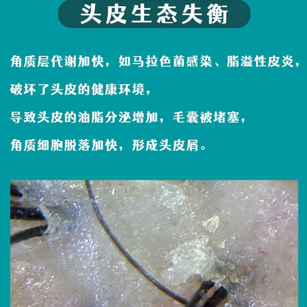 止癢洗髮水排行榜