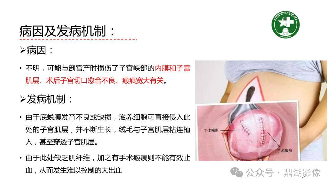 剖宮產術後子宮瘢痕妊娠的mri診斷_影像_全網_解剖圖