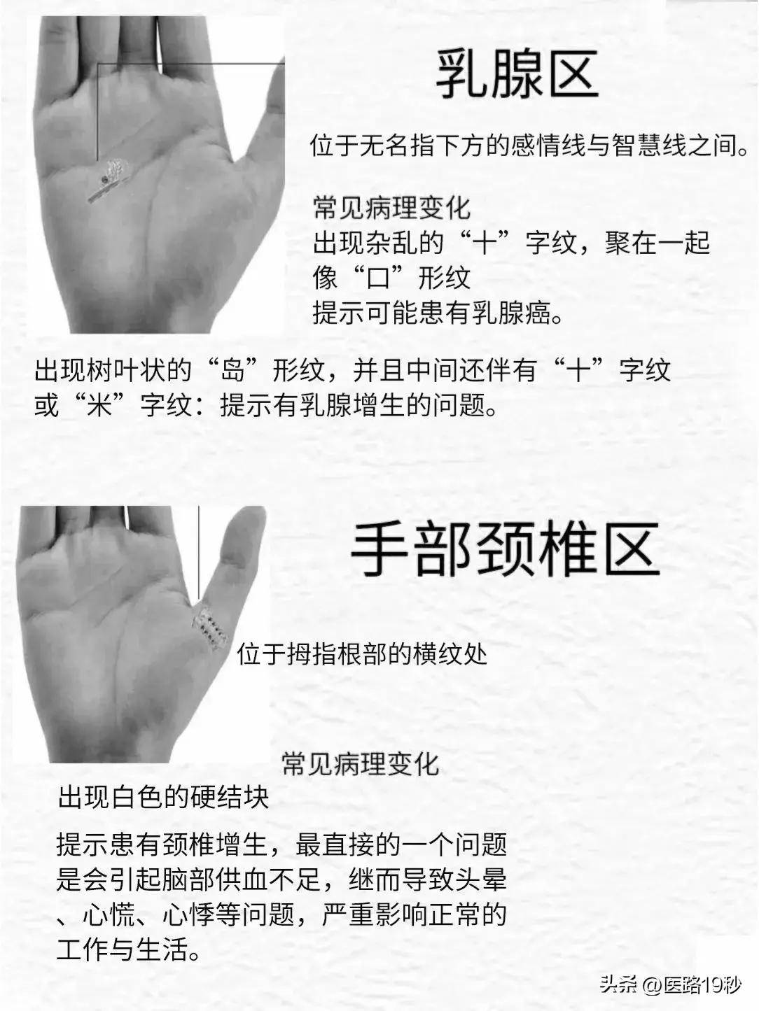 手上的这些"岛"形纹和"米"字纹都代表什么意义?