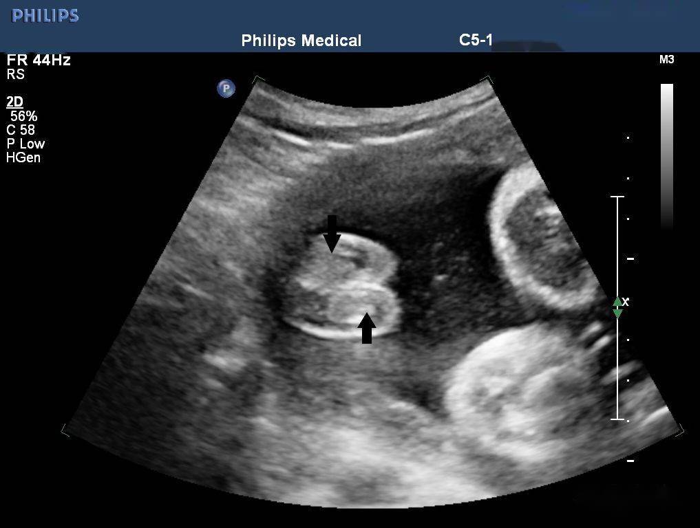 二维超声:胎儿双侧阴囊内可见睾丸回声(图 1)