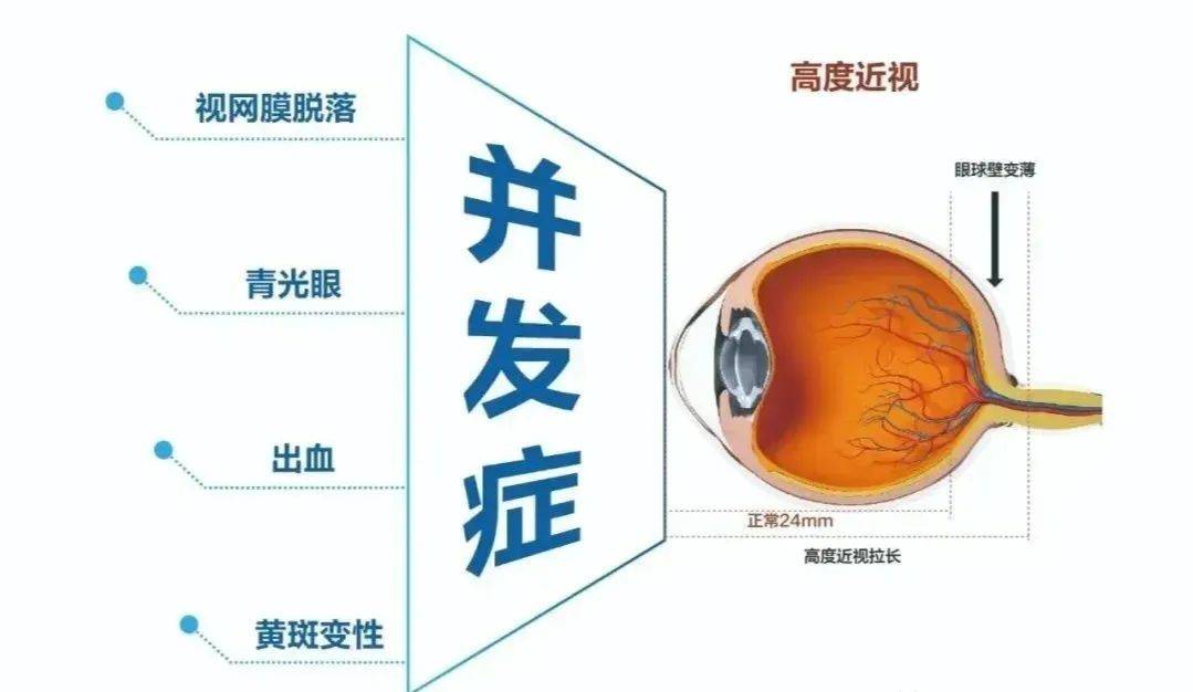 5,青光眼正常人眼球内容物大部分是液体,会对眼球壁产生压力,称之眼压