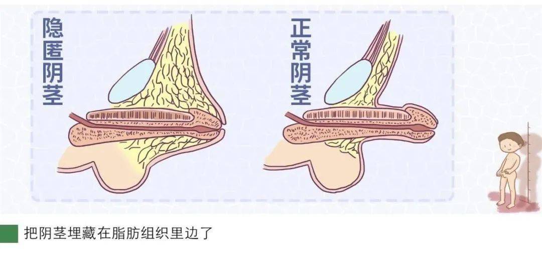 男孩包皮都能一割了之吗?