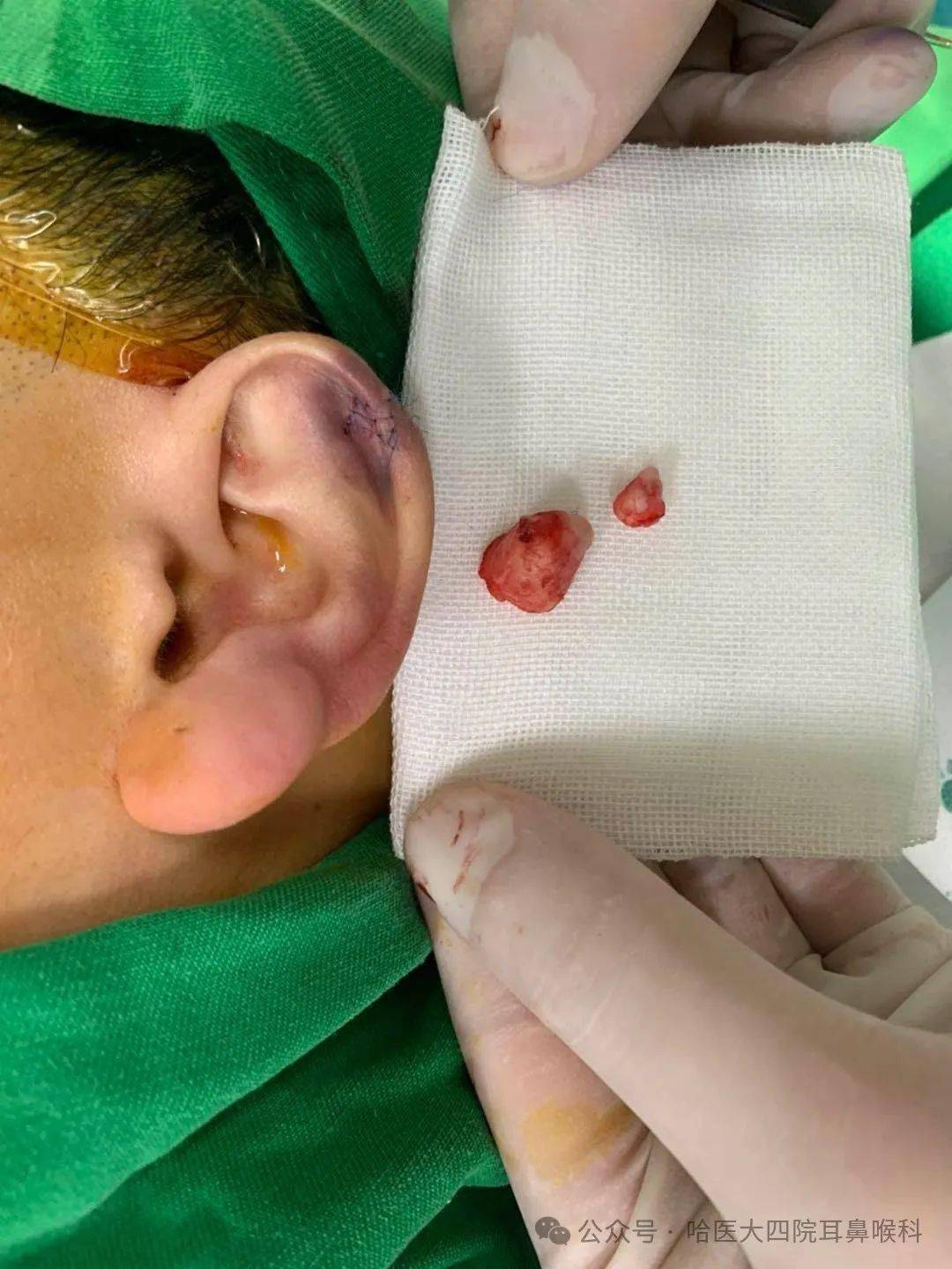 目前联合治疗仍是最有效和最安全的治疗策略,比如手术切除瘢痕疙瘩后