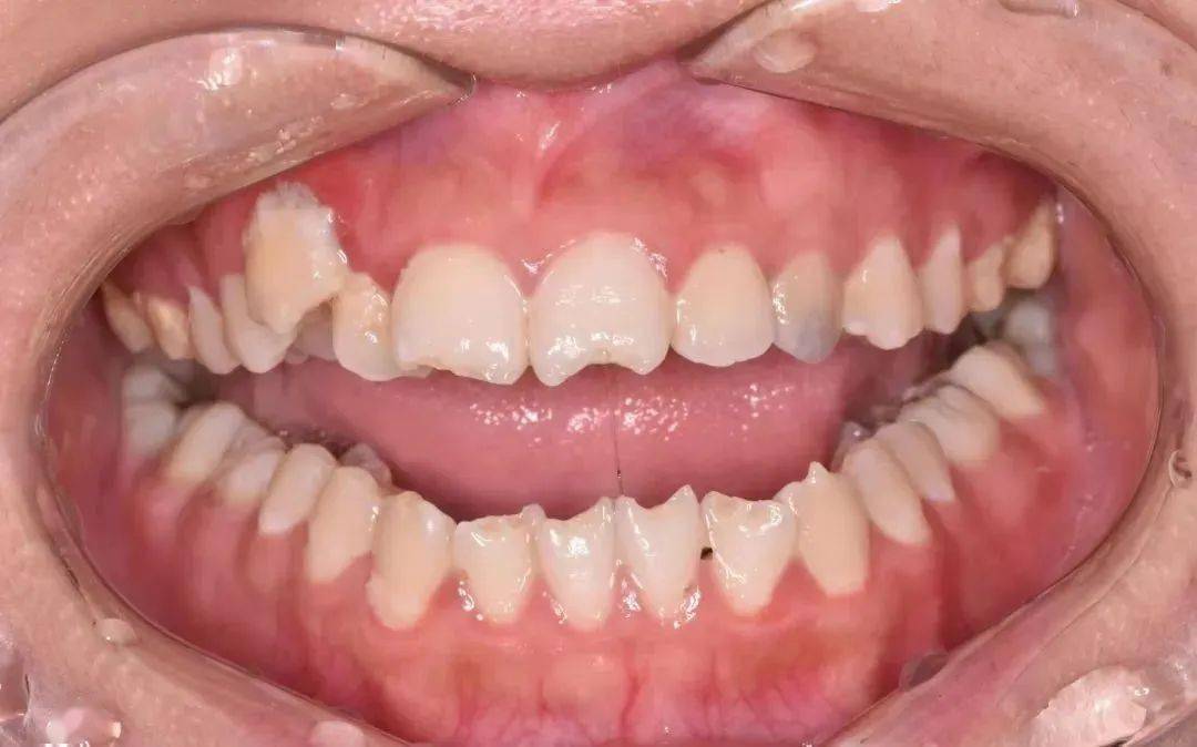 孩子梅毒牙齿症状图片图片