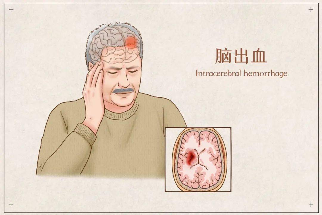 一场豪饮引发的悲剧脑出血俗称脑溢血,简单的理解就是脑子里面出血了.