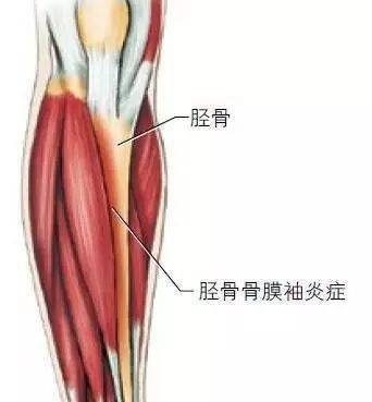 識別方法在比賽結束後,腿部或脛骨內側(靠近身體中線)的症狀通常包括