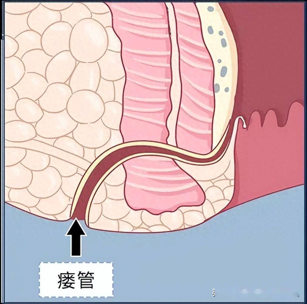 乳腺瘘管照片症状图片