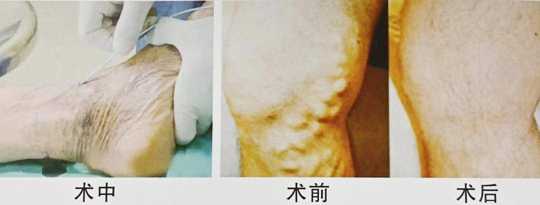 小结节的克星——微波消融技术_进行_病变_甲状腺