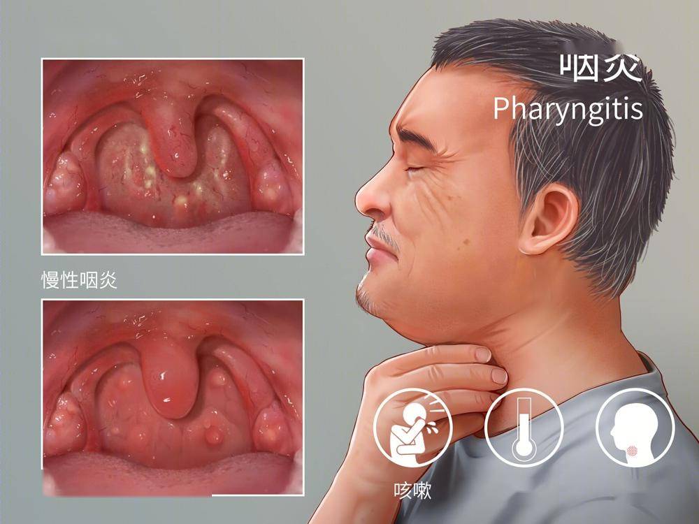 喉咙正常图片和发炎图片