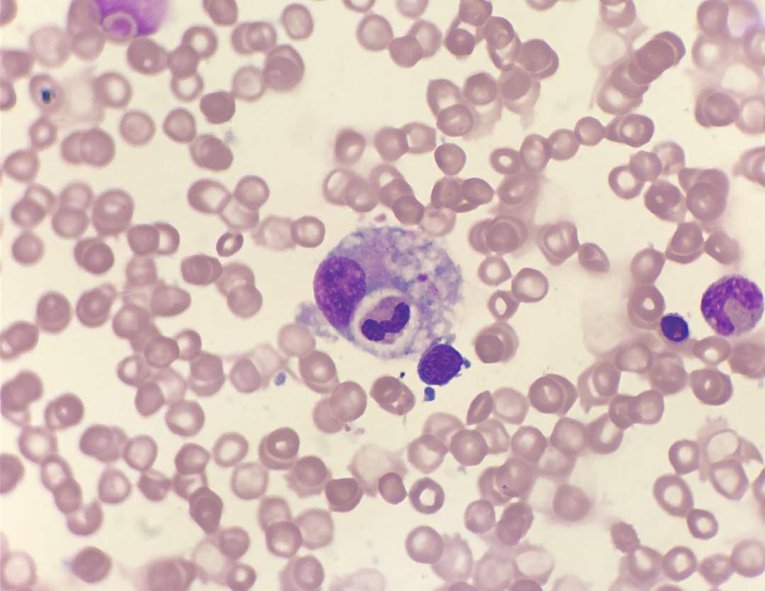 不久,患儿骨髓标本送检至检验科,对其染色镜检,可见吞噬红细胞