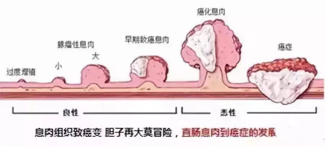 膀胱息肉与膀胱癌图片图片