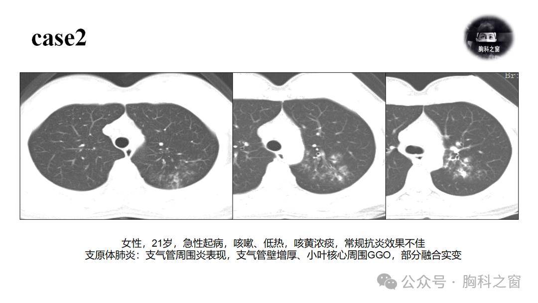 支氣管炎或細支氣管炎模式:小葉中心結節,支氣管壁增厚大葉性實變模式