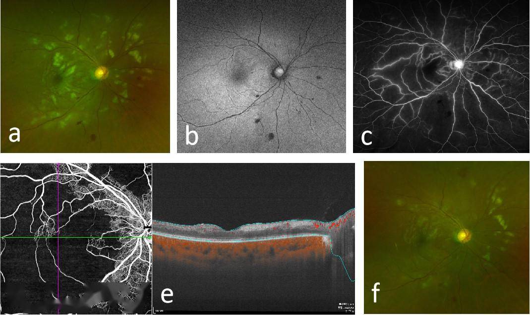 erythematosus: clinical features, risk factors and prognosis