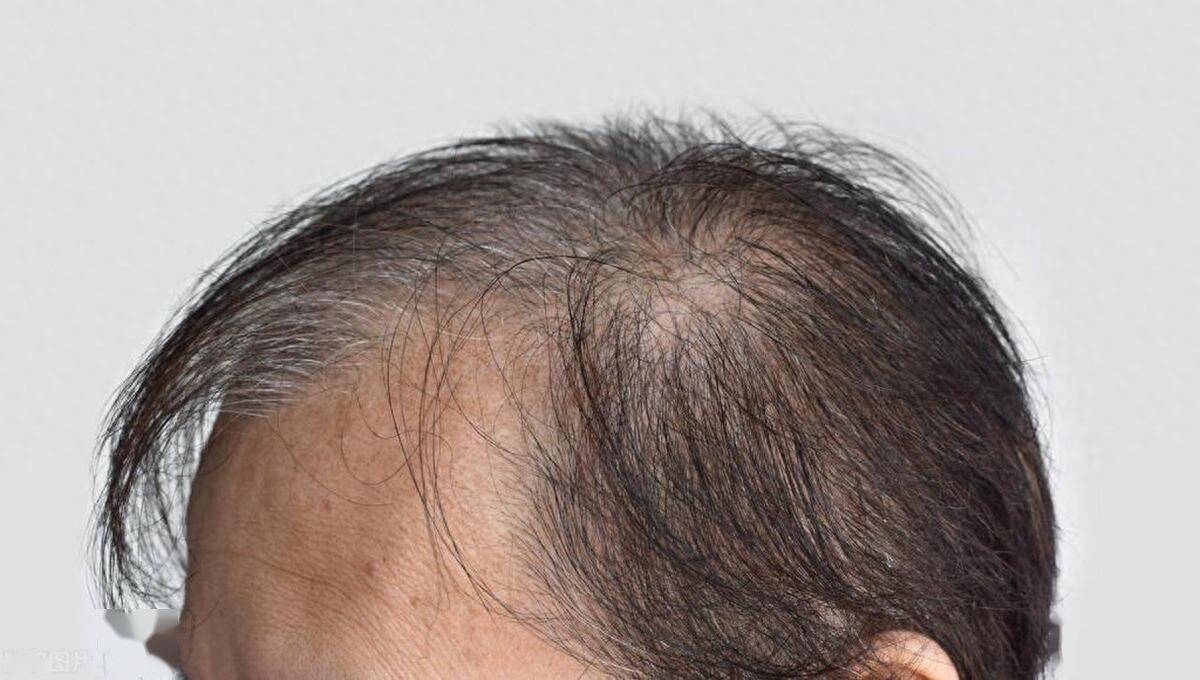 其中雄激素性脱发是最多的类型,男女表现各异,男性呈m型秃,先从前额