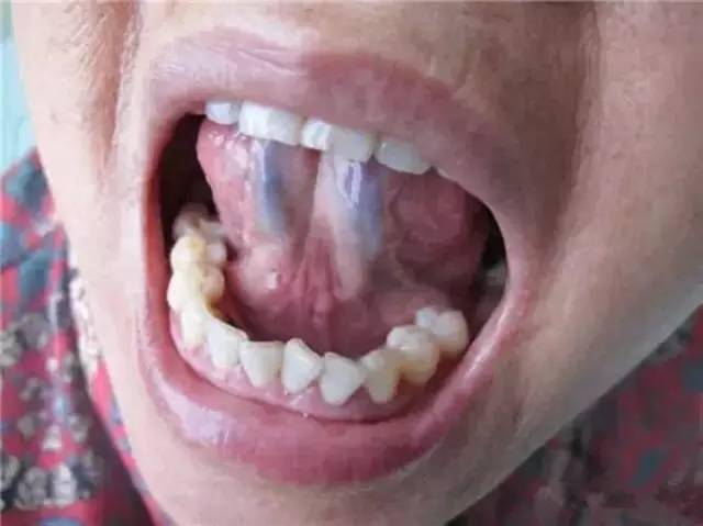 6毫米以下,长度不超过舌系带止点,整条舌下静脉无扭曲,怒张.