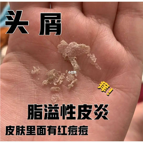 去屑脫髮洗髮水排行榜_頭皮