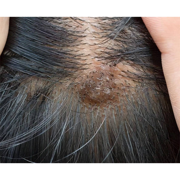 控油止痒去屑洗发水推荐