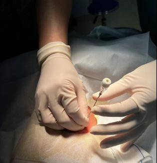 国际儿童癌症日③ | 儿童恶性肿瘤穿刺活检,家长必读