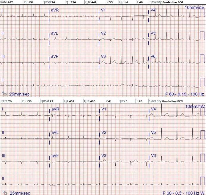 图 1  晕厥发作过程的心电变化医生回顾了一下老王意识丧