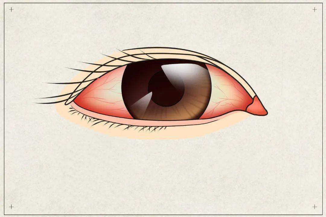 常见的有角膜炎,结膜炎,像红眼病等,而非感染性炎症有巩膜炎,虹膜结状