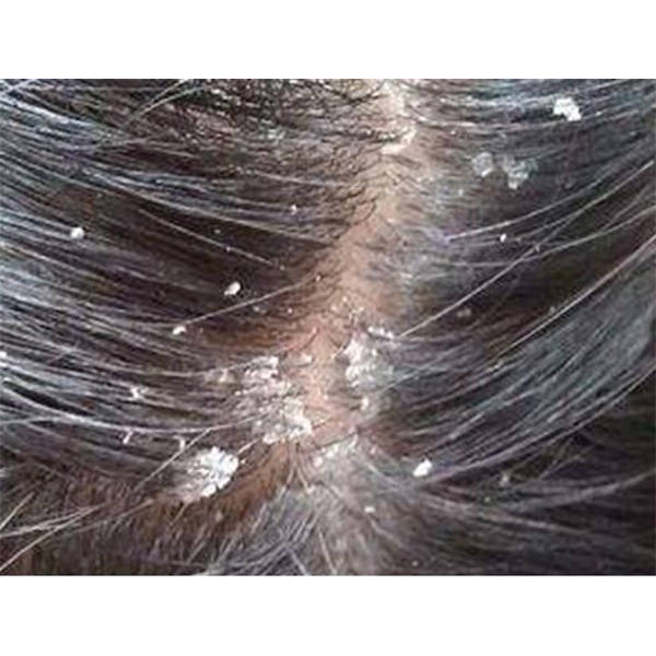 脂溢性皮炎通常由皮脂腺分泌过多的皮脂所致,导致头皮过度油腻,为真菌