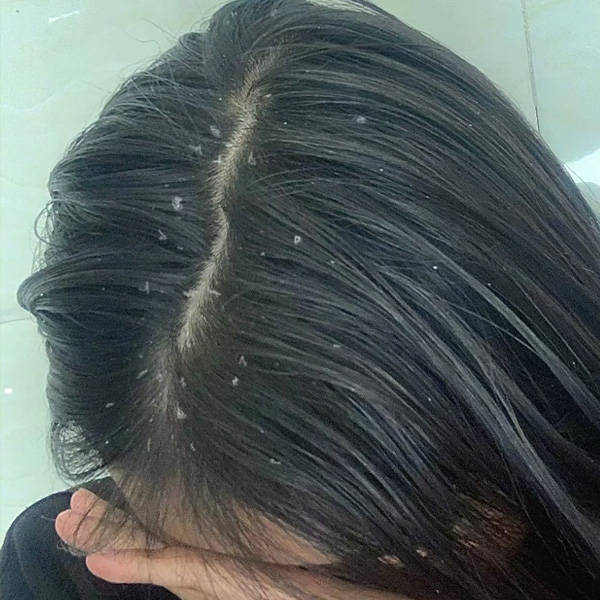 去除头皮屑最有效的洗发水推荐_头发_产品_问题