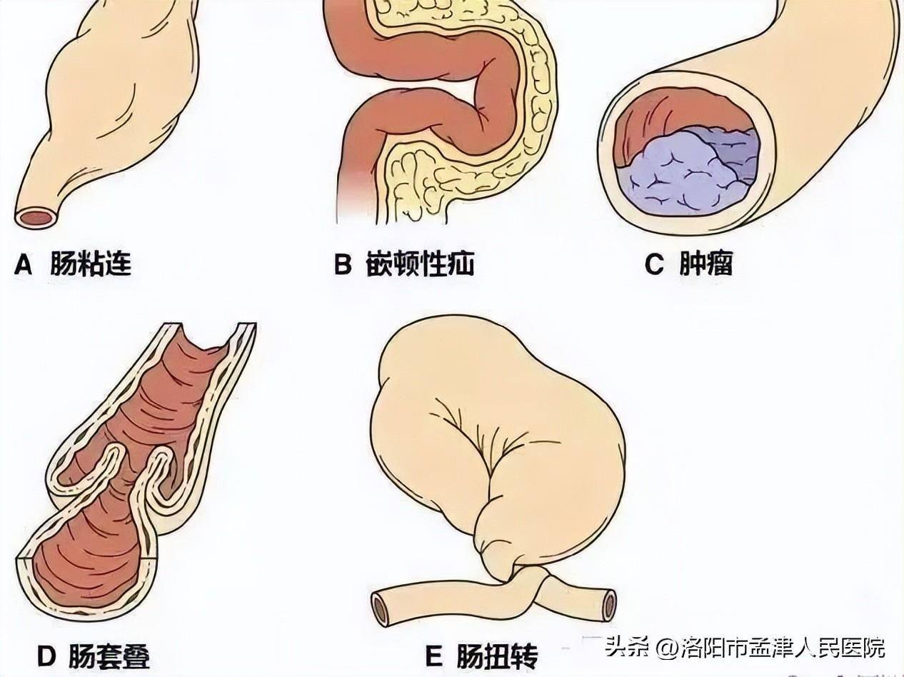 肠梗阻图片卡通图片图片