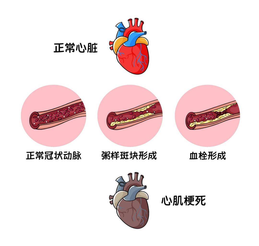 冠心病是什么病图片