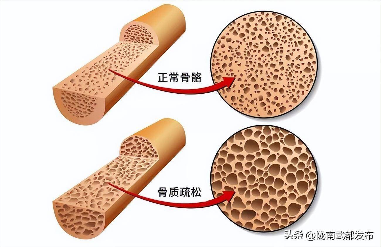 豆腐是骨质疏松的发物?