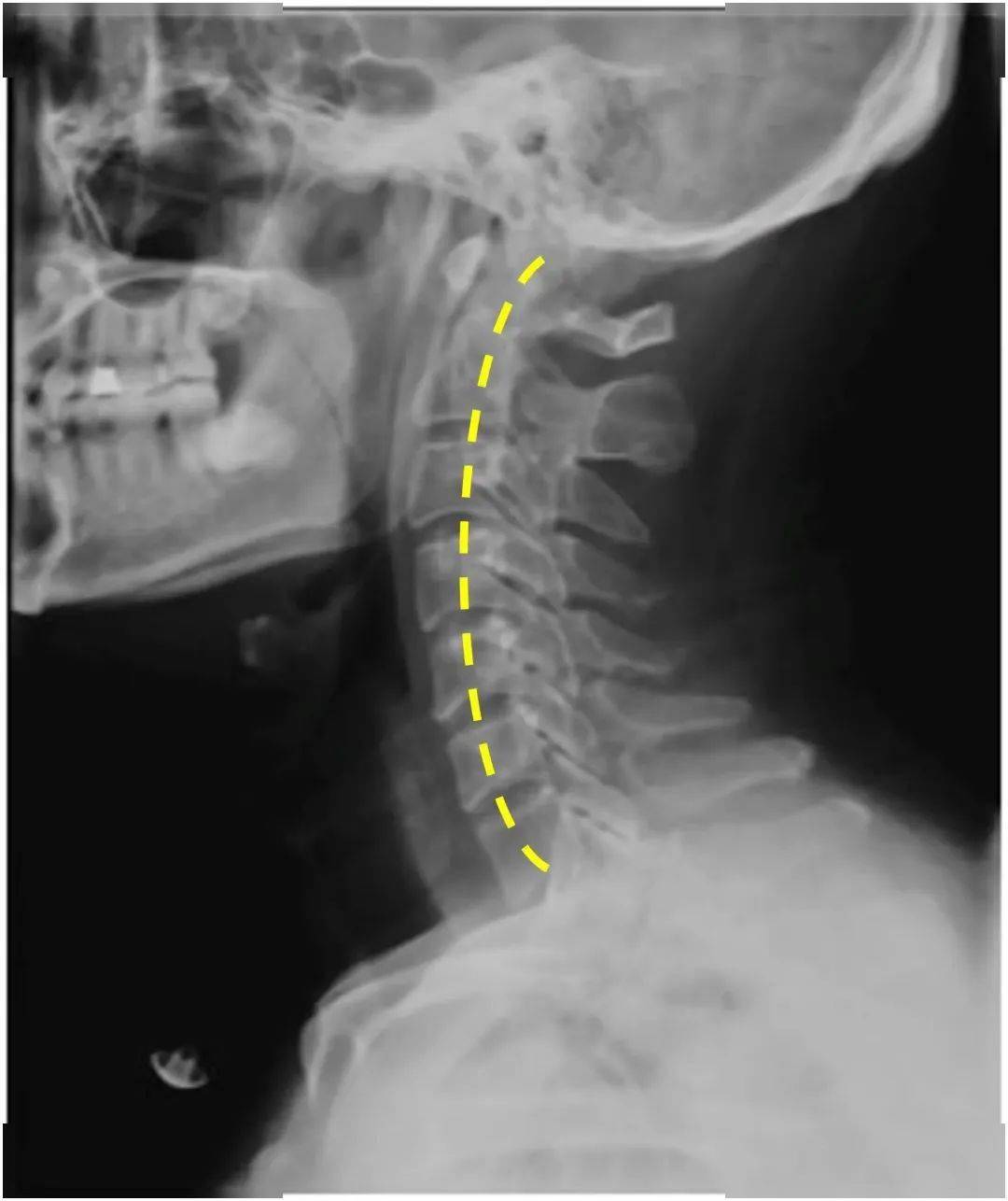 颈椎前凸消失图片