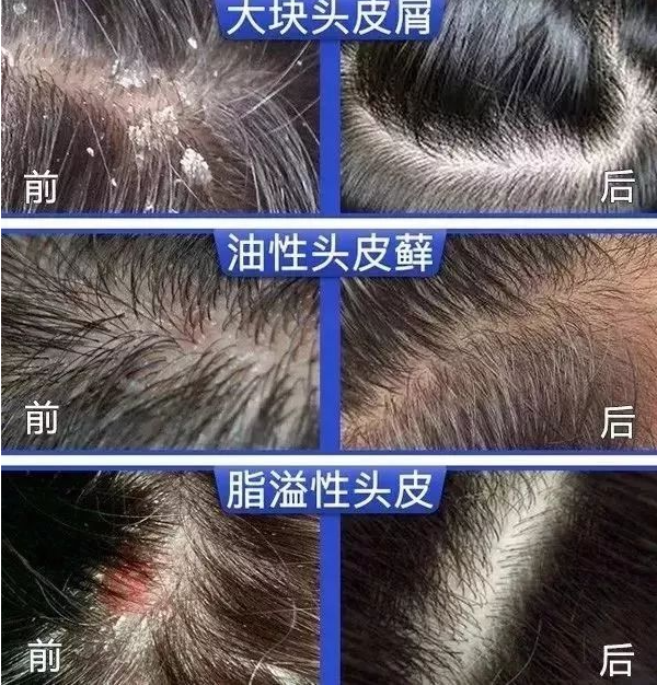 男女通用去屑洗发水推荐_头皮屑_头发_问题