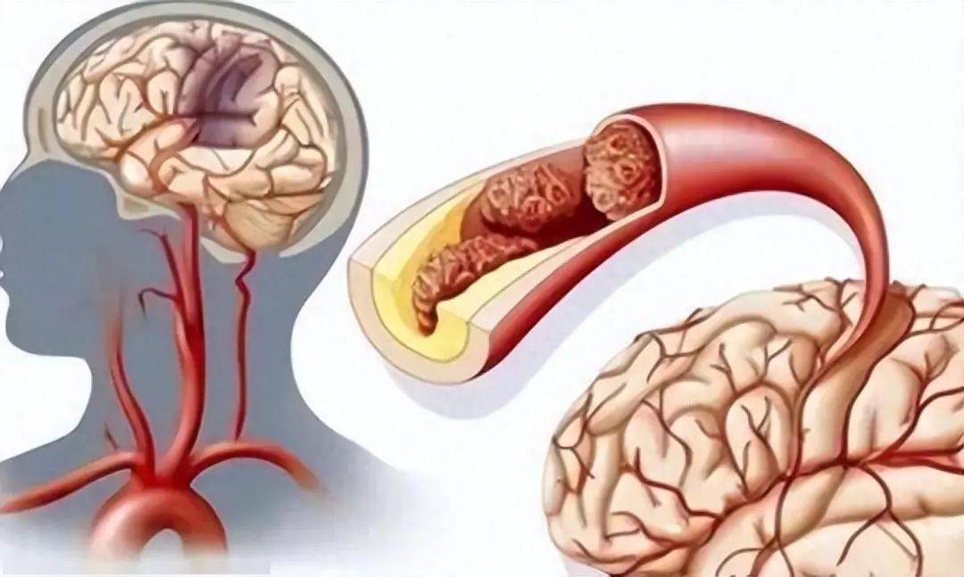 老人若耳朵有三个异常,要当心是否是脑梗_脑血管_患者_生活习惯