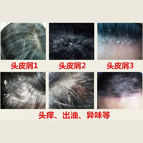 洗发水国产推荐_头皮屑_效果_成分