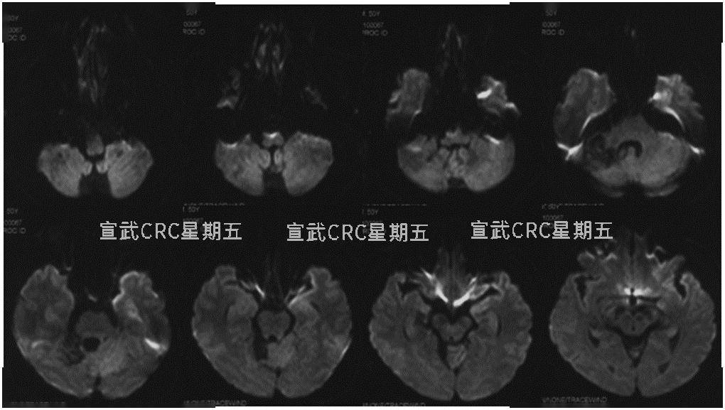 继续给予替罗非班 氯吡格雷方案抗栓治疗,加用甲强龙减轻缺血后脊髓