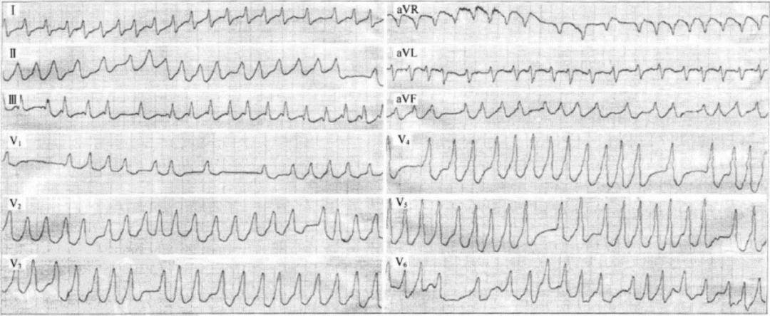 酷似室速的心电图图片