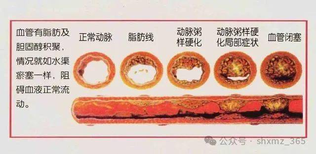 血管堵塞的十大征兆图片