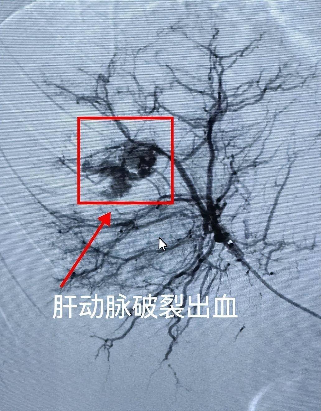 股动脉进行穿刺插管,通过"米粒"大小创面,在dsa引导下对主要肝内出血