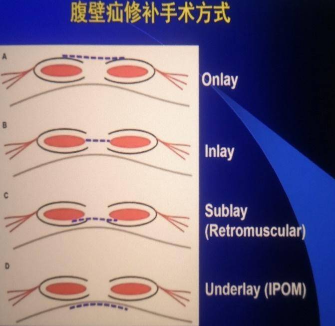 【健康科普】前沿技术减轻患者经济负担—腹腔镜下完全腹膜外腹壁疝