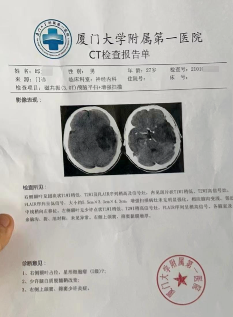 脑肿瘤ct图片报告图片