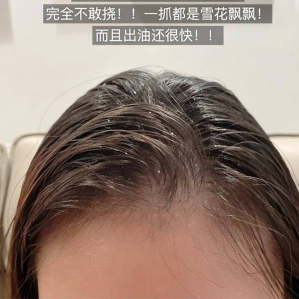 什么洗发水止痒去屑效果最好_男士_头皮屑_女士