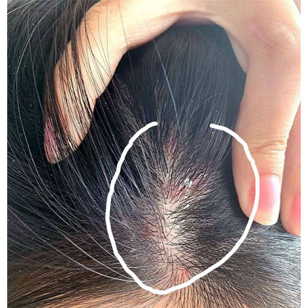 头发里长红疙瘩毛囊炎用什么洗发水?_头皮屑_问题_去屑