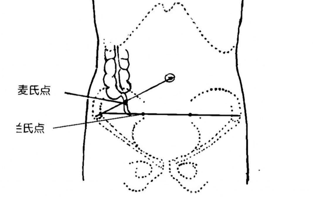 阑尾压痛点的位置图片图片