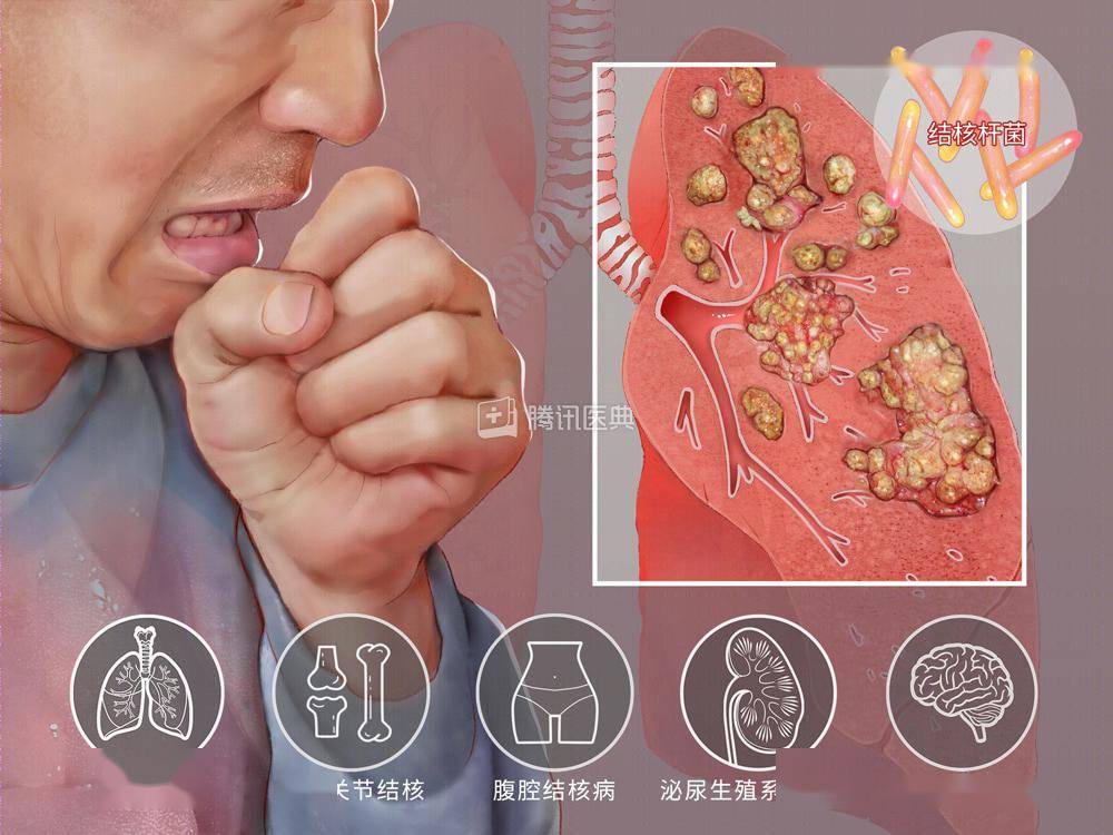 及早接种卡介苗,为宝宝穿上第一道"盔甲"_结核_儿童_部位
