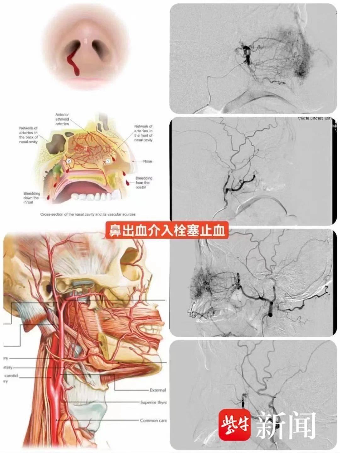 肛门飙血!这项技术"快准狠"堵漏_血管_医学_鼻子