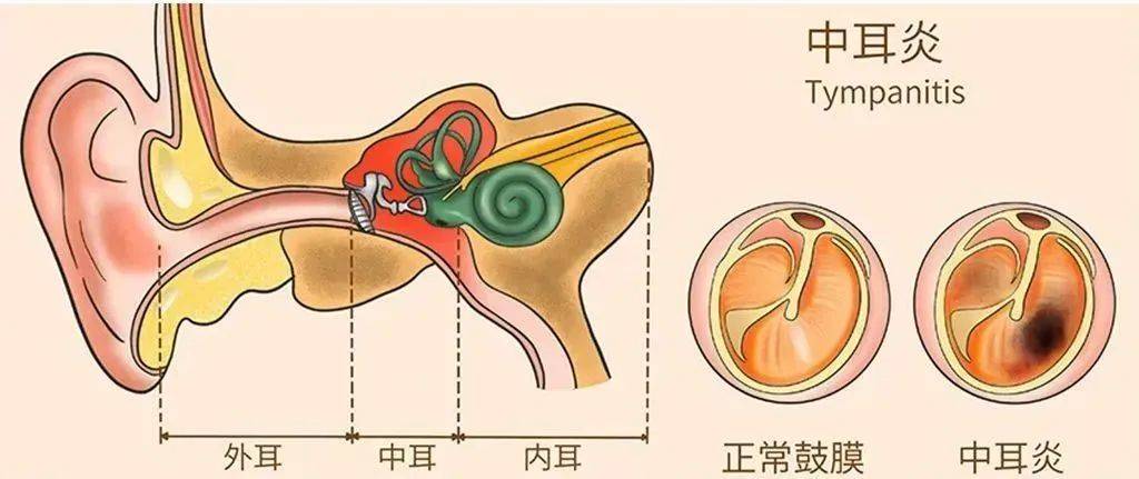与扇耳光一样有"杀伤力",医生提醒这样的病例很常见_鼓膜_外耳道_炎症