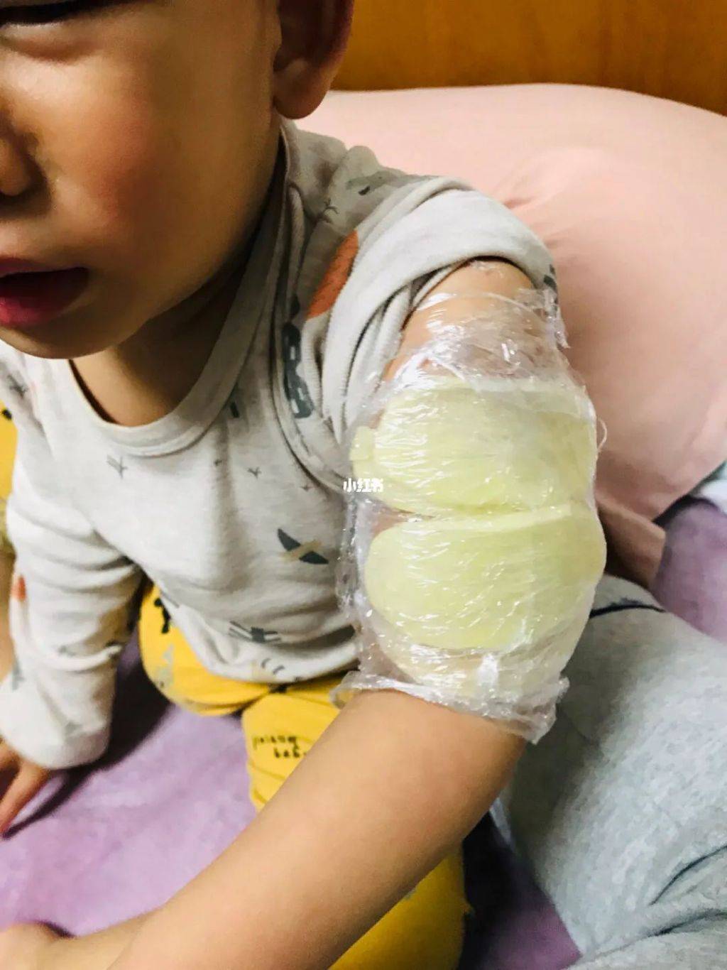 做ct增强打针的地方鼓包了,"冰镇硒土豆"有妙招_对比_检查_血管