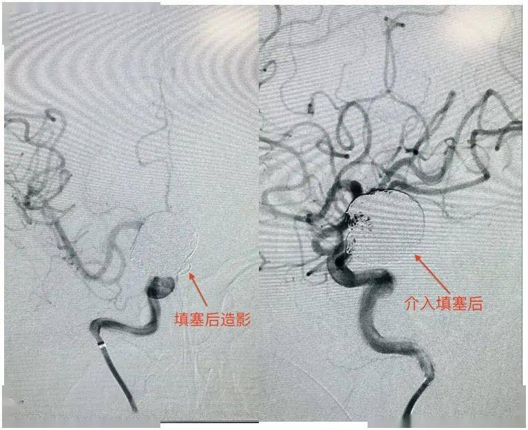 医院神经外科团队成功拆除两枚颅内不定时"炸弹"_施大妈_检查_脑血管
