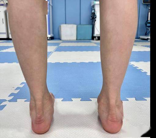 警惕足外翻!_孩子_康复师_儿童